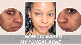 Dermatologists Guide to FUNGAL ACNE  What is it amp Treatments [upl. by Siednarb]