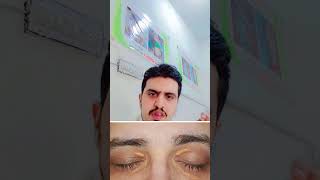 Xanthelasma  Best treatment  shortsfeed [upl. by Damas]