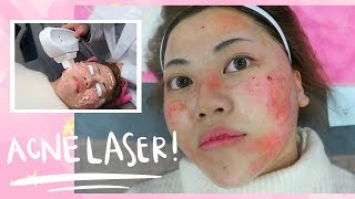 Painful ACNE LASER Experience in Korea [upl. by Florentia]