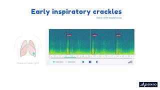 Lung sounds  Early inspiratory crackles [upl. by Anod]