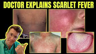 Doctor explains SCARLET FEVER Group A Streptococcal disease  CAUSES SYMPTOMS amp TREATMENT [upl. by Paulo]