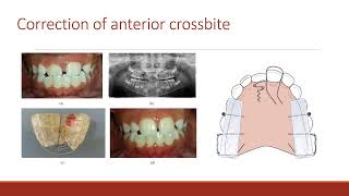 5 kurs 1 leksiya Removable and fixed orthodontic appliances [upl. by Vashtia784]