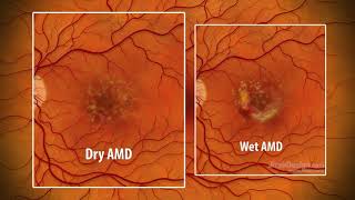 Macular Degeneration  an animated explanation [upl. by Anawd]