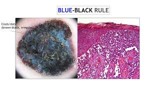 Nodular melanoma  Dr Ketty Peris [upl. by Nnyroc247]