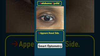 Eyelid Coloboma optometry optometrist optometrists optometrista eyedisease eyediseases eyelid [upl. by Etirugram]