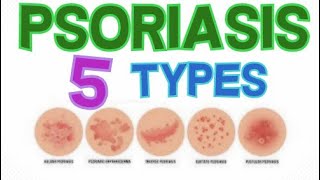 THE 5 MAIN TYPES OF PSORIASIS  PSORIASIS CLASSIFICATION [upl. by Niloc920]