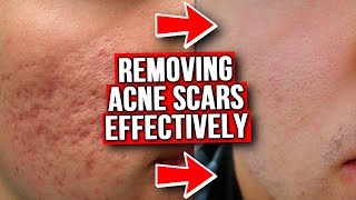 GET RID OF ACNE SCARS FROM EXPERIENCE [upl. by Uella]