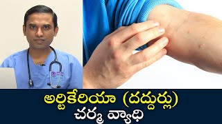 Urticaria skin disease  Samayam Telugu [upl. by Llewsor372]