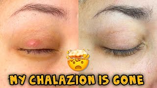 Update My Chalazion is Gone  How did I get rid of it [upl. by Sorensen]