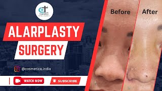 Alarplasty With Nasal Osteotomies [upl. by Aicenert]