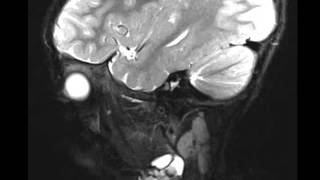 Venolymphatic Malformation [upl. by Epps]