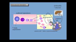 Anemia of increased red cell destruction loss [upl. by Enilhtak]