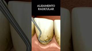 ALISAMENTO COM RASPAGEM raspagemdental shortsfeed shortsvideo shortsdental resumosdeodonto [upl. by Ahsilek653]