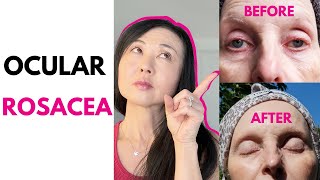 Ocular Rosacea Before and After [upl. by Campball]