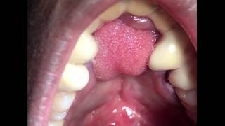 Anterior Palatal Fistula  Tongue flap debulking and contouring [upl. by Nereen351]