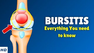 Bursitis – Types Causes Signs and Symptoms Diagnosis amp Treatment [upl. by Cudlip]