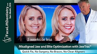 Misaligned Jaw Alignment and Bite Correction Without Surgery Braces or Aligners [upl. by Anavlys842]