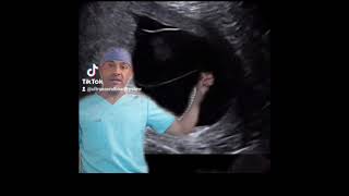 Monochorionic Diamnionic Ultrasound [upl. by Caraviello]