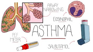 Asthma Explained Including Pathophysiology [upl. by Noraha]