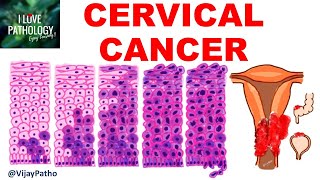 Squamous Intraepithelial lesion amp CANCER CERVIX [upl. by Cheke]