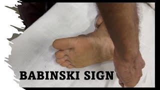 Babinski Sign The Extensor Plantar [upl. by Dwinnell]