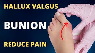 Hallux Valgus Treatment without Surgery [upl. by Eneliak]