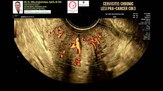 Cervicitis chronic  Lesi Pracancer  CIN 3 [upl. by Diahann460]