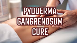 Treatment of Pyoderma gangrenosum [upl. by Anabella]