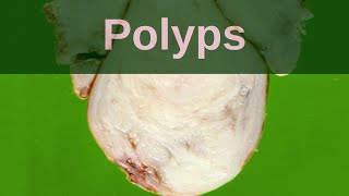 What are Polyps  Pathology mini tutorial [upl. by Remlap]