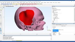 How to Design a PatientSpecific Cranial Plate  Mimics Innovation Suite  Materialise Medical [upl. by Aicila]