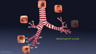 Mastering Bronchoscopy for Thoracic Surgery Chapter 1 [upl. by Attelliw694]