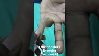 TRIGGER FINGER Stenosing Tenosynovitis flexordigitorumprofundus [upl. by Nirda471]