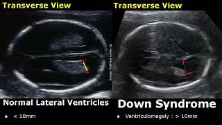 Fetal Ultrasound Normal Vs Down Syndrome  Soft Markers In Fetus For Trisomy 21  Aneuploidies USG [upl. by Aitenev]