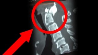 SURVIVING AN ODONTOID PROCESS C2 FRACTURE  quotThe Amazing Recoveryquot [upl. by Lowenstein]