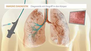 Idiopathische Lungenfibrose MusikLeiser2 [upl. by Atteval3]