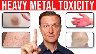 4 Skin Signs That Reveal Heavy Metal Toxicity [upl. by Aivun]