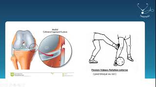 Lésions ligamentaires du Genou  Docteur Ould Chakmakdji [upl. by Meyers807]