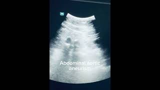 Abdominal aortic aneurism with intraluminal hematoma echocardiography ultrasound cardiacimaging [upl. by Ernaldus517]