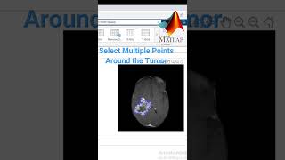 Extract Tumor by Image Segmentation MATLAB DICOM image [upl. by Merril]