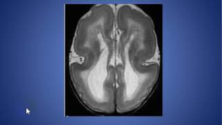 radiolgy cases lissencephaly [upl. by Alcot716]