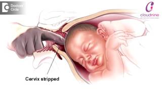 Methods of Labour Induction  Dr Padmini Isaac  Cloudnine Hospitals [upl. by Edmead]