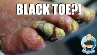 GANGRENE TOE ON A DIABETIC PATIENT [upl. by Labanna]