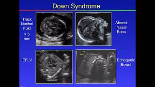 Fetal Congenital anomalies part2 [upl. by Hansel]