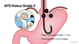 GERD  Endoscopic Evaluation  Assessment of antireflux mechanism [upl. by Bruis]