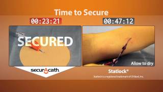 SecurAcath vs Statlock securement time [upl. by Eibreh]