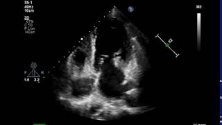 Mitral valve vegetation infective endocarditis [upl. by Elleinet211]