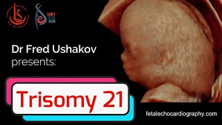 Trisomy 21 Challenges in screening diagnosis and management of Downs syndrome [upl. by Tillinger]