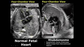 Fetal Chest Ultrasound Normal Vs Abnormal Image Appearances  Echocardiography  Heart amp Lungs USG [upl. by Loy628]