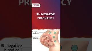 RH Negative Pregnancy  Dr Debashish Sarkar drdebashishsarkar sarkarhospital rhnegativepregnancy [upl. by Zurciram]