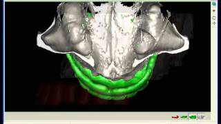 SimPlant  Dual Scan versus Single Scan [upl. by Karel]